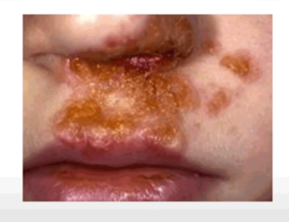 impetigo